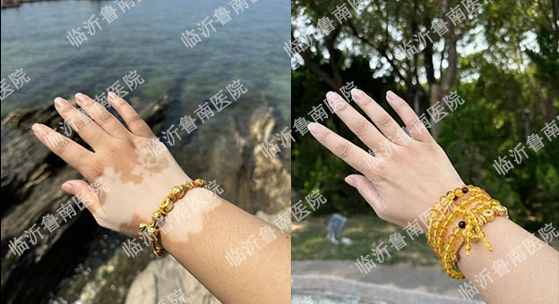 10白癜風(fēng)該如何治療護(hù)理臨沂皮膚病醫(yī)院哪家好