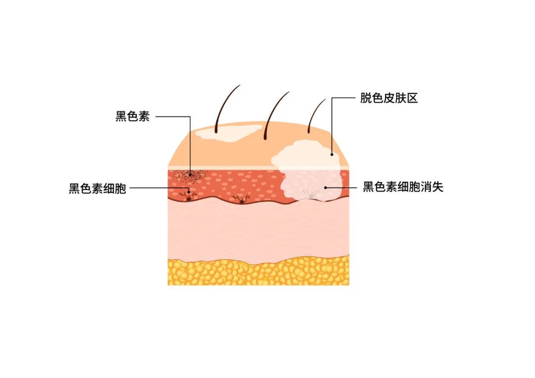 11白癜風紋身--這樣遮白不靠譜臨沂皮膚病醫(yī)院哪家好