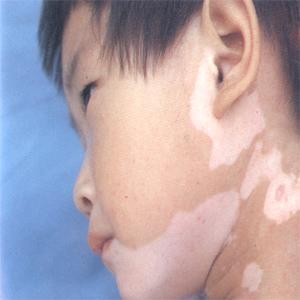冬季白癜風(fēng)患者的注意事項(xiàng)