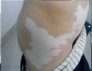 白癜風(fēng)會影響女性患者生育嗎